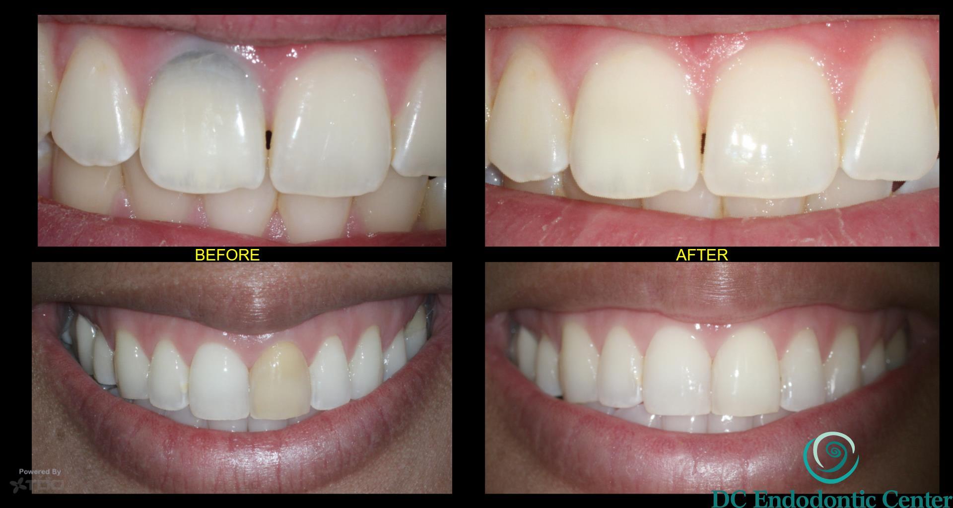 Intracoronal bleaching - dc endodontic center